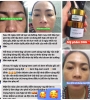 BỘ BA PEEL DA ĐIỀU TRỊ
