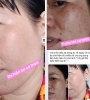 BỘ BA PEEL DA ĐIỀU TRỊ