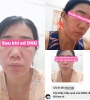 BỘ BA PEEL DA ĐIỀU TRỊ