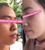 BỘ BA PEEL DA ĐIỀU TRỊ