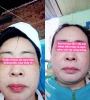 BỘ BA PEEL DA ĐIỀU TRỊ